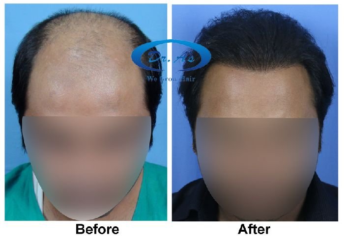 Dr Arvind Hair Transplant Result 4