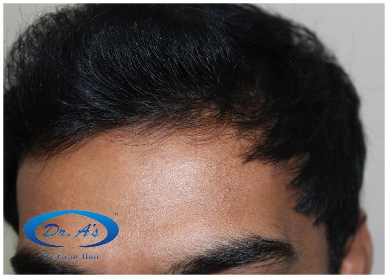 Dr Arvind Hair Transplant Result 9