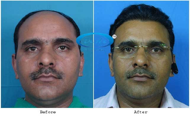Dr Arvind Poswal Hair Transplant India 12