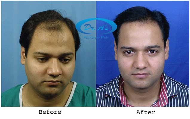 Dr Arvind Poswal Hair Transplant India 17
