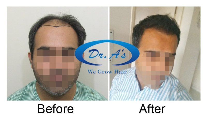 Dr Arvind Poswal Hair Transplant India 28
