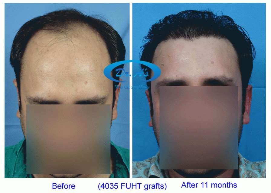 Dr Arvind Poswal Hair Transplant India 33
