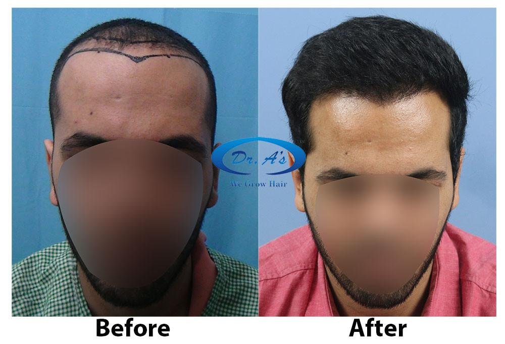 Dr Arvind Poswal Hair Transplant India 36