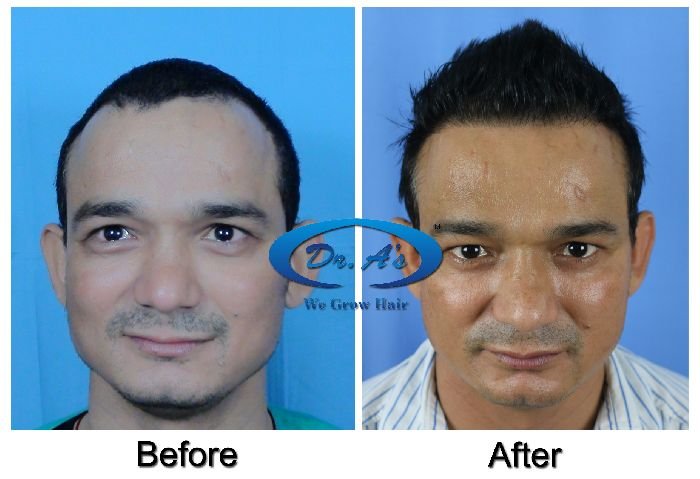 Dr Arvind Poswal Hair Transplant India 48