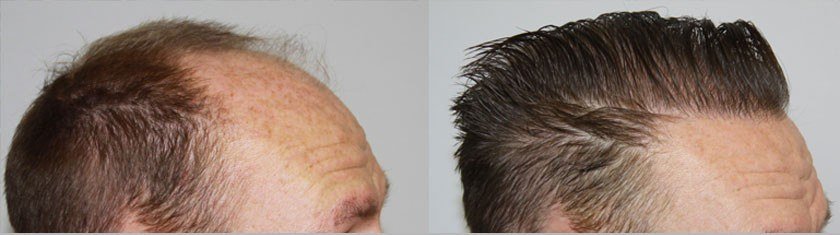 Dr Baubac Hair Transplant Results 14