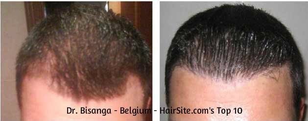 dr bisanga hair transplant reviews belgium