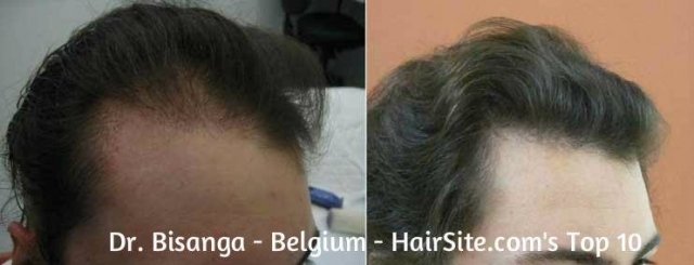 dr bisanga hair transplant reviews belgium