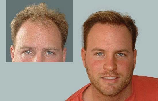 Dr Cole Hair Transplant Result 2