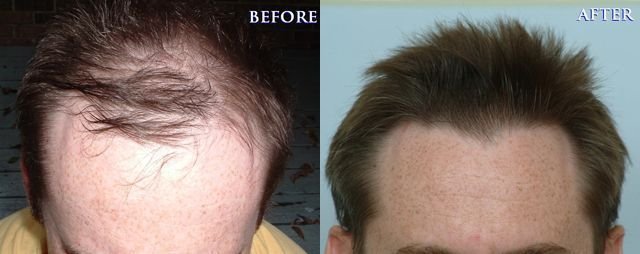 Dr Cole Hair Transplant Result 26