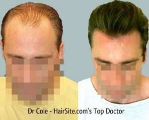 dr cole hair transplant reviews 1