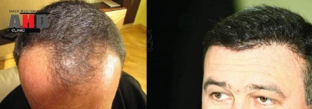 dr hakan doganay hair transplant result