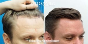 Dr Hasson Fue 1310 grafts