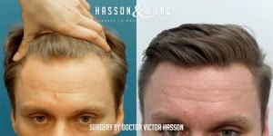 Dr Hasson Fue 1310 grafts