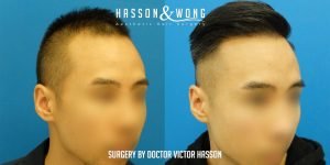 Dr Hasson Fue 2274 grafts