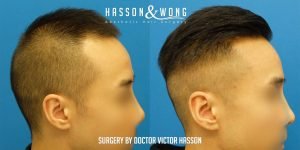 Dr Hasson Fue 2274 grafts