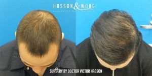 Dr. Hasson FUE 2274 grafts