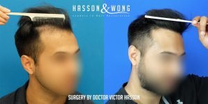 Dr. Hasson FUE 2593 grafts