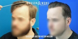Dr. Hasson FUE 2640 grafts