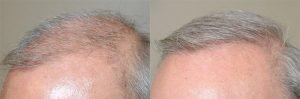 Dr Jeffrey Epstein Hair Transplant Reviews