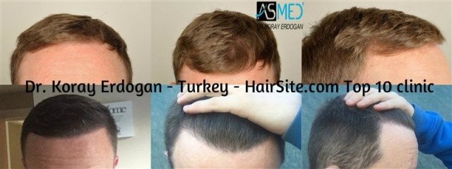 dr koray erdogan hair transplant reviews turkey
