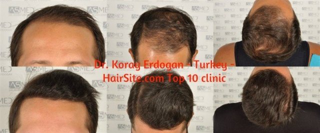dr koray erdogan hair transplant reviews turkey