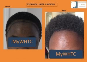 dr mwamba hair transplant belgium