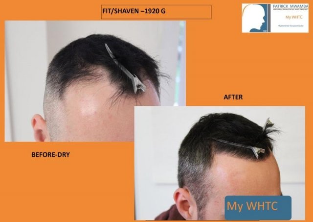 dr mwamba hair transplant belgium