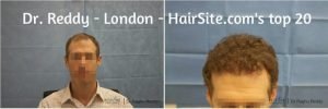 dr reddy hair transplant reviews london