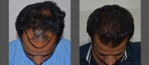 dr-suneet-soni-hair-transplant-result-10