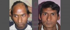 dr-suneet-soni-hair-transplant-result-19