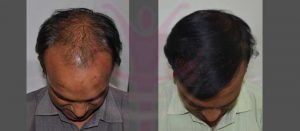 dr-suneet-soni-hair-transplant-result-8