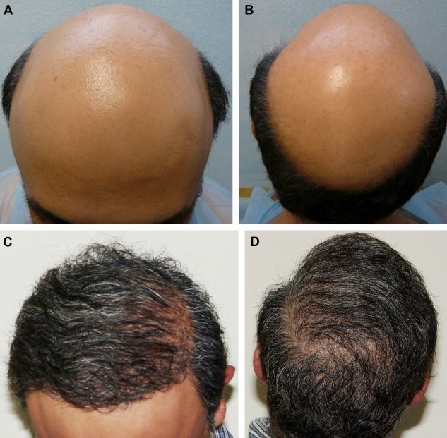 Dr Umar Body Hair Transplant Results 1 