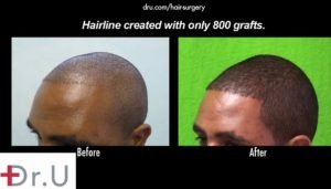 Dr Umar Hair Transplant Results