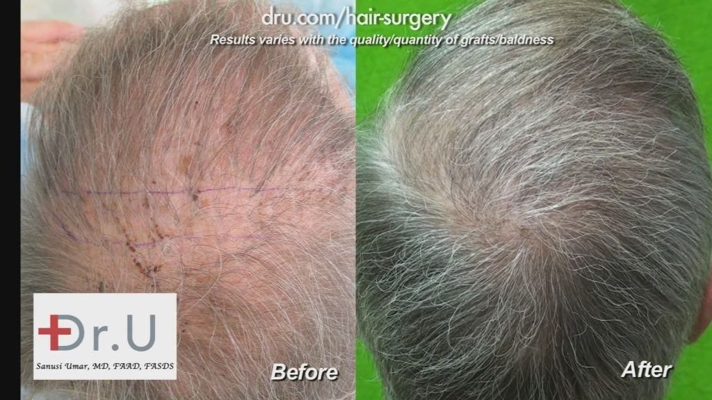 Dr Umar Hair Transplant Reviews Los Angeles 5
