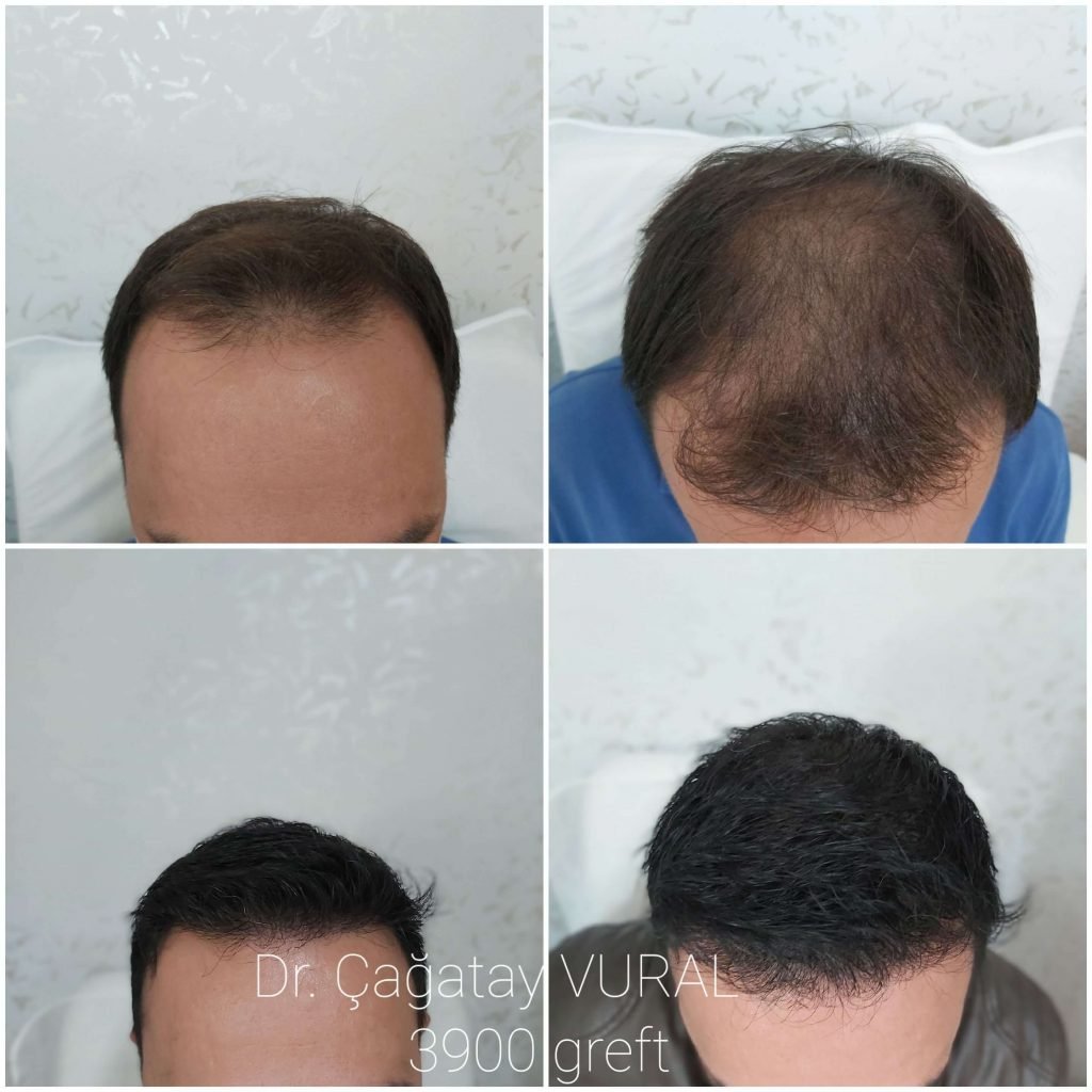 Dr Vural Hair Transplant Result 2