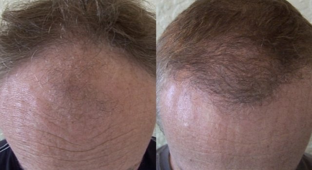 dr woods hair transplant result