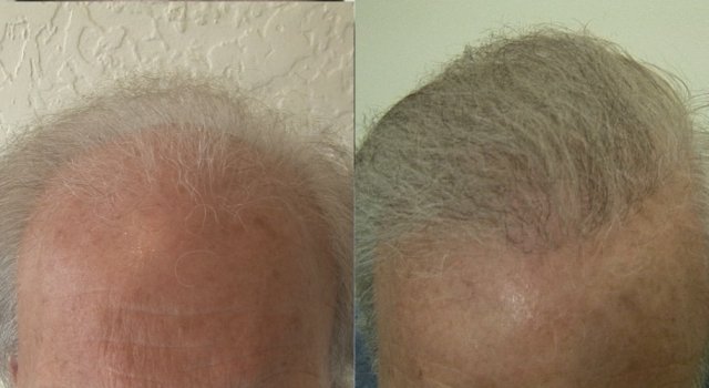 dr woods hair transplant result