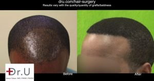 Fue Hair Transplant Training Results