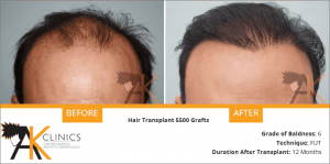 fut-strip-hair-transplant-result-7