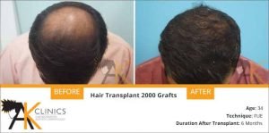 hair-transplant-result-16