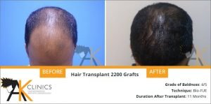 hair-transplant-result-17