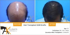 hair-transplant-result-20