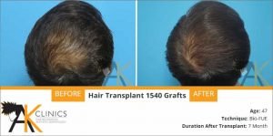 hair-transplant-result-23