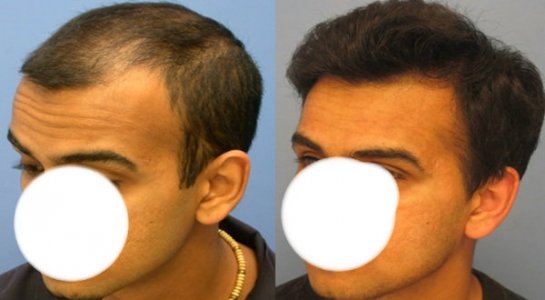 Hasson Wong hair transplant reviews Vancouver