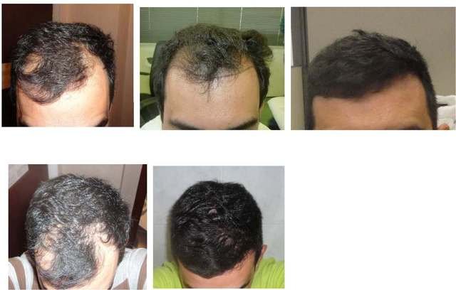 HDC hair transplant review cyprus images 