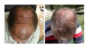 hdc hair transplant reviews cyprus