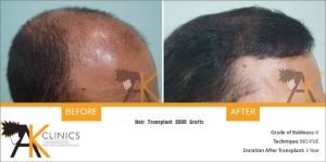 india-bio-fue-hair-transplant-11