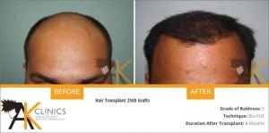 india-bio-fue-hair-transplant-result-6