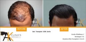 india-fue-hair-transplant-12