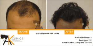 india-fue-transplant-result-2
